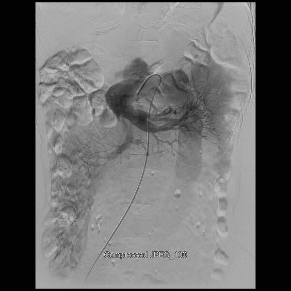 File:Abernethy malformation (Radiopaedia 42006-45462 Frontal Superior mesenteric artery 12).jpg