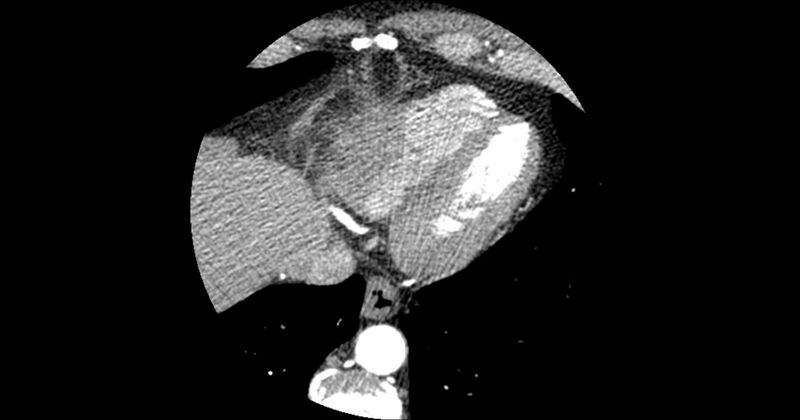 File:Aberrant left main coronary artery (ALMCA) arising from the right sinus with interarterial course (Radiopaedia 63251-71814 Axial C+ arterial phase 170).JPG