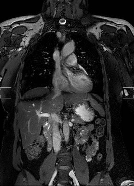 File:Aberrant right subclavian artery with background Takayasu arteritis (Radiopaedia 21423-21363 Coronal MRA 11).jpg