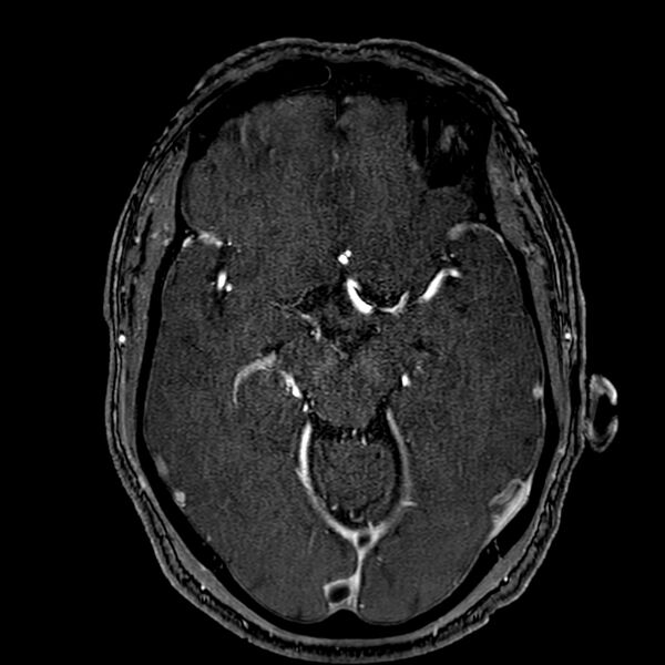 File:Accessory middle cerebral artery (Radiopaedia 73114-83828 Axial MRA 78).jpg