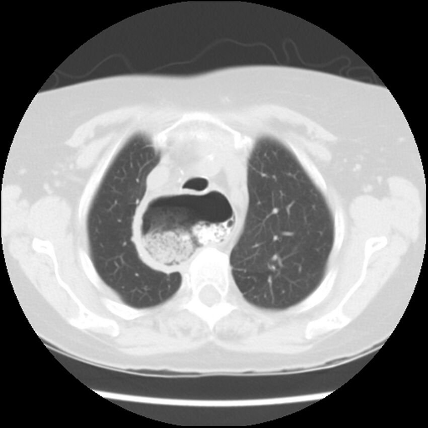 Achalasia (Radiopaedia 44094-47649 Axial lung window 12).jpg