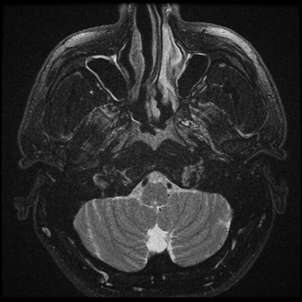 File:Acoustic schwannoma - intracanalicular (Radiopaedia 37247-39024 Axial T2 fat sat 2).jpg