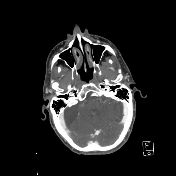 File:Acute ICA ischemic penumbra due to high-grade CCA stenosis (CT perfusion) (Radiopaedia 72038-82530 Axial C+ arterial phase 18).jpg
