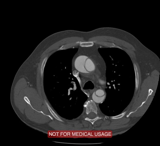 File:Acute aortic dissection - Stanford type A (Radiopaedia 40661-43285 Axial C+ arterial phase 15).jpg