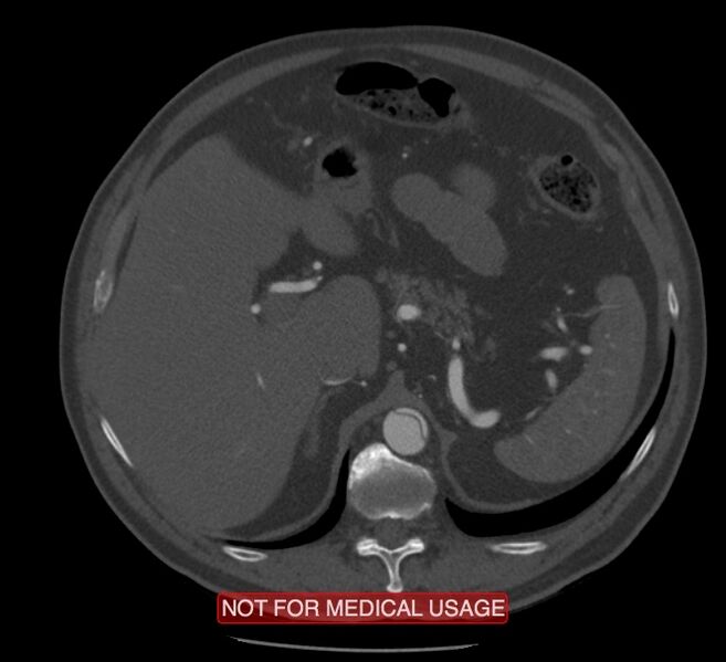 File:Acute aortic dissection - Stanford type A (Radiopaedia 40661-43285 Axial C+ arterial phase 82).jpg