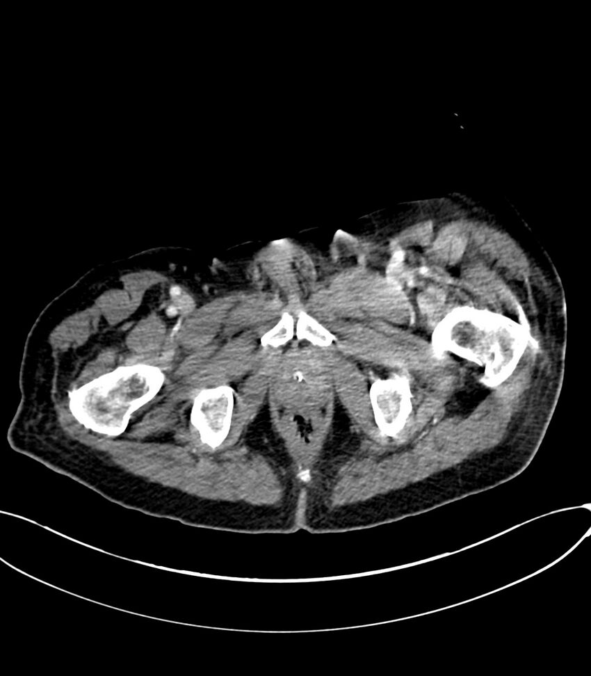 Acute arterial mesenteric ischemia (Radiopaedia 78238-90828 Axial C+ portal venous phase 146).jpg