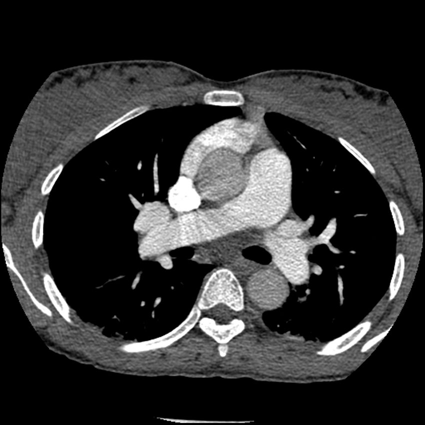 Acute chest syndrome - sickle cell disease (Radiopaedia 42375-45499 Axial C+ CTPA 82).jpg