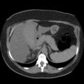 Acute cholecystitis and ureteric colic (Radiopaedia 42330-45444 Axial prone 22).jpg