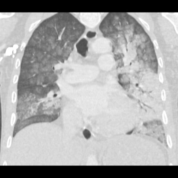 File:Acute diffuse alveolar hemorrhage (Radiopaedia 41323-44158 Coronal lung window 26).jpg