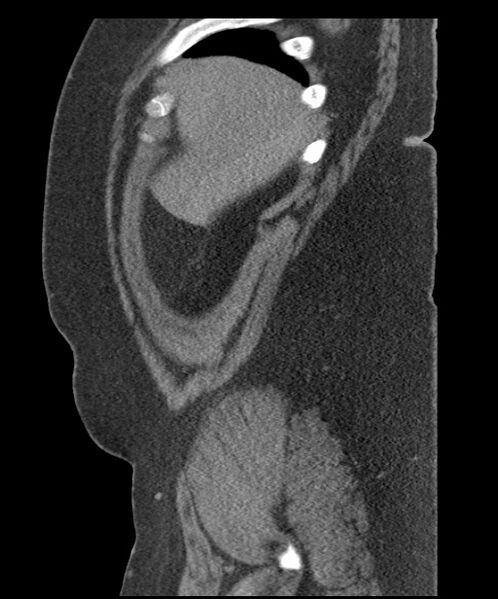 File:Acute mesenteric venous ischemia (Radiopaedia 46041-50383 Sagittal C+ portal venous phase 12).jpg