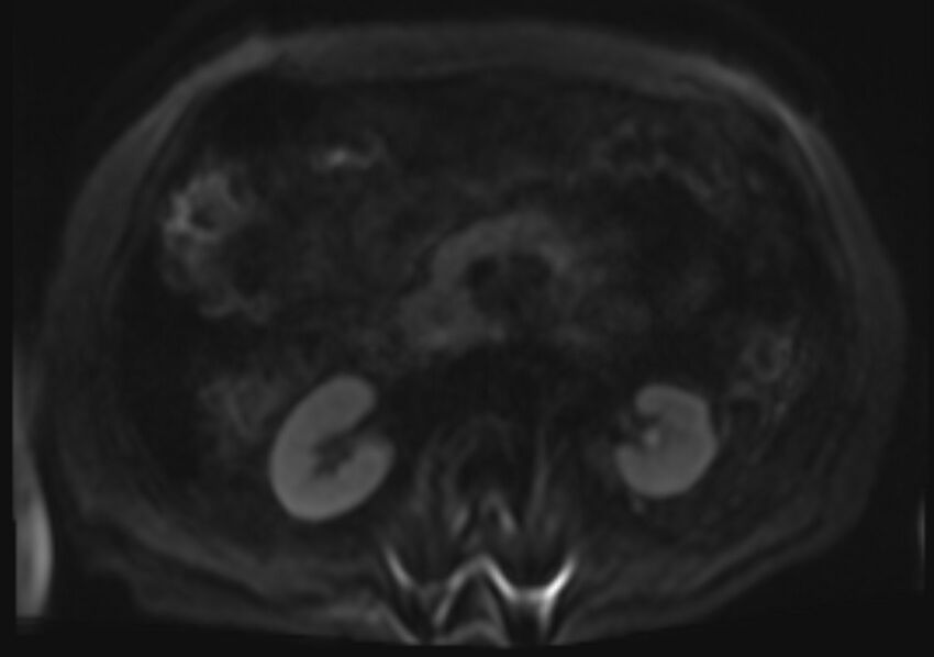 Acute portal vein thrombosis (Radiopaedia 73198-83925 Axial DWI 50).jpg