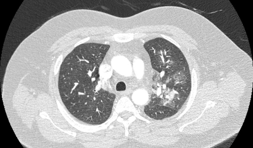 Acute pulmonary embolism with pulmonary infarcts (Radiopaedia 77688-89908 Axial lung window 32).jpg