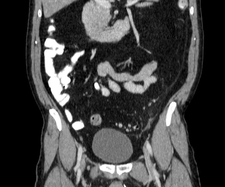 File:Acute sigmoid colon diverticulitis (Radiopaedia 55507-61976 Coronal C+ portal venous phase 65).jpg