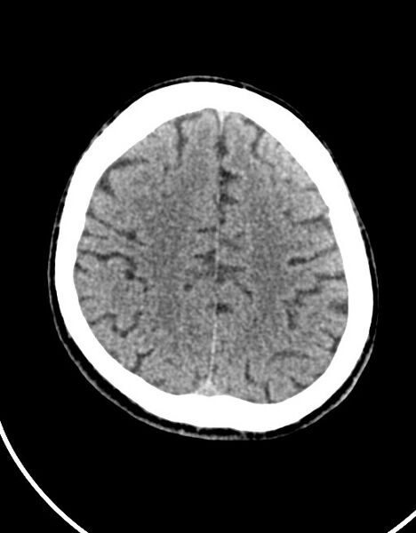 File:Acute superior cerebellar artery territory infarct (Radiopaedia 84104-99359 Axial non-contrast 22).jpg