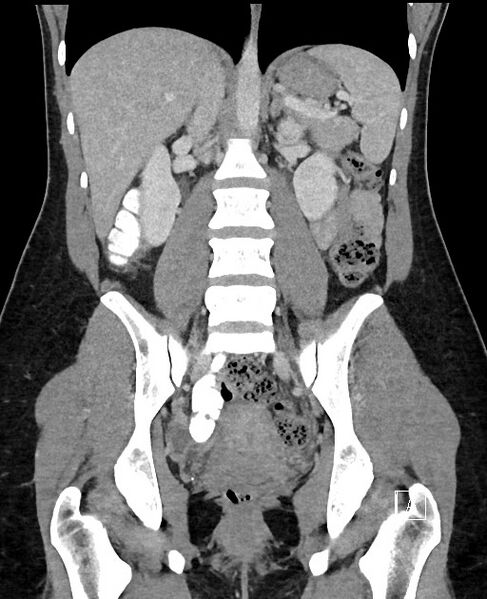 File:Acute uncomplicated appendicitis (Radiopaedia 61374-69304 Coronal C+ portal venous phase 62).jpg