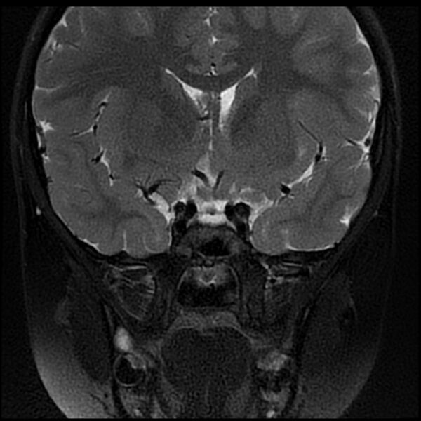 File:Adamantinomatous craniopharyngioma (Radiopaedia 77407-89529 Coronal T2 fat sat 4).jpg