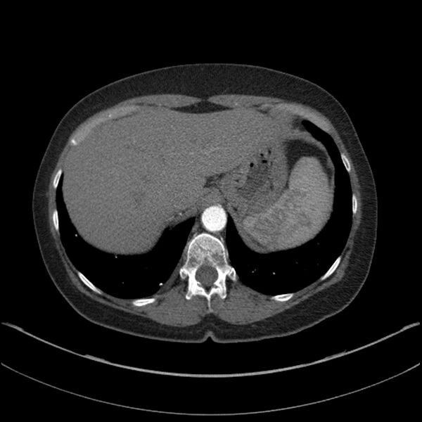 File:Adenocarcinoma of the lung (Radiopaedia 44205-47803 Axial C+ portal venous phase 74).jpg