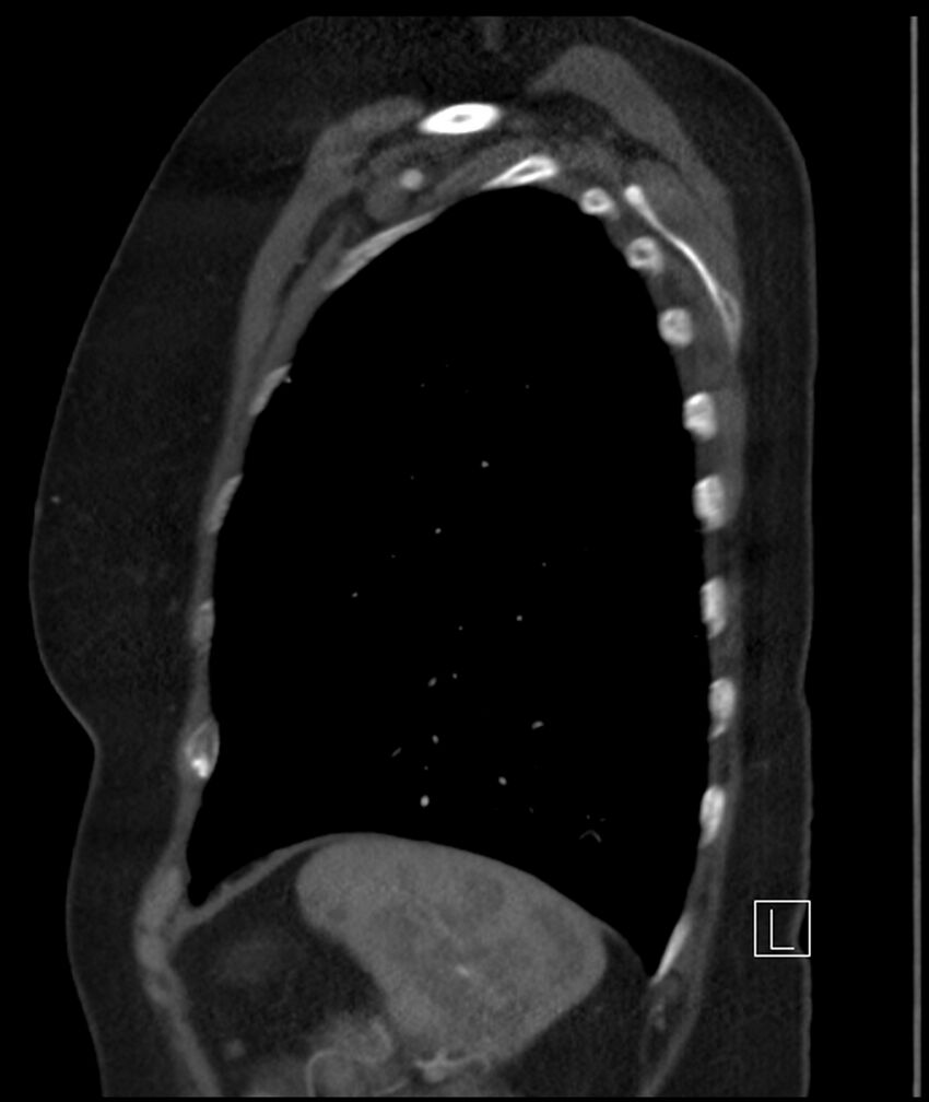 Adenocarcinoma of the lung (Radiopaedia 44205-47803 Sagittal C+ portal venous phase 11).jpg