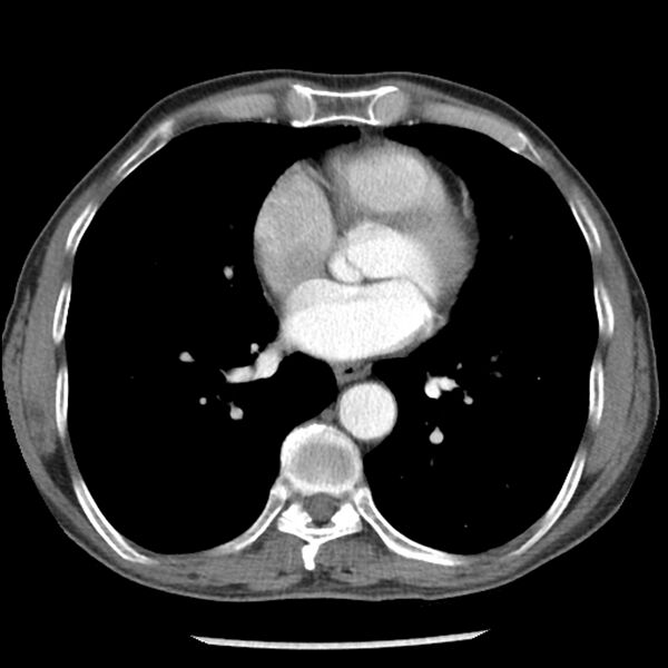 File:Adenocarcinoma of the lung - micropapillary predominant (Radiopaedia 42446-45563 Axial C+ portal venous phase 46).jpg
