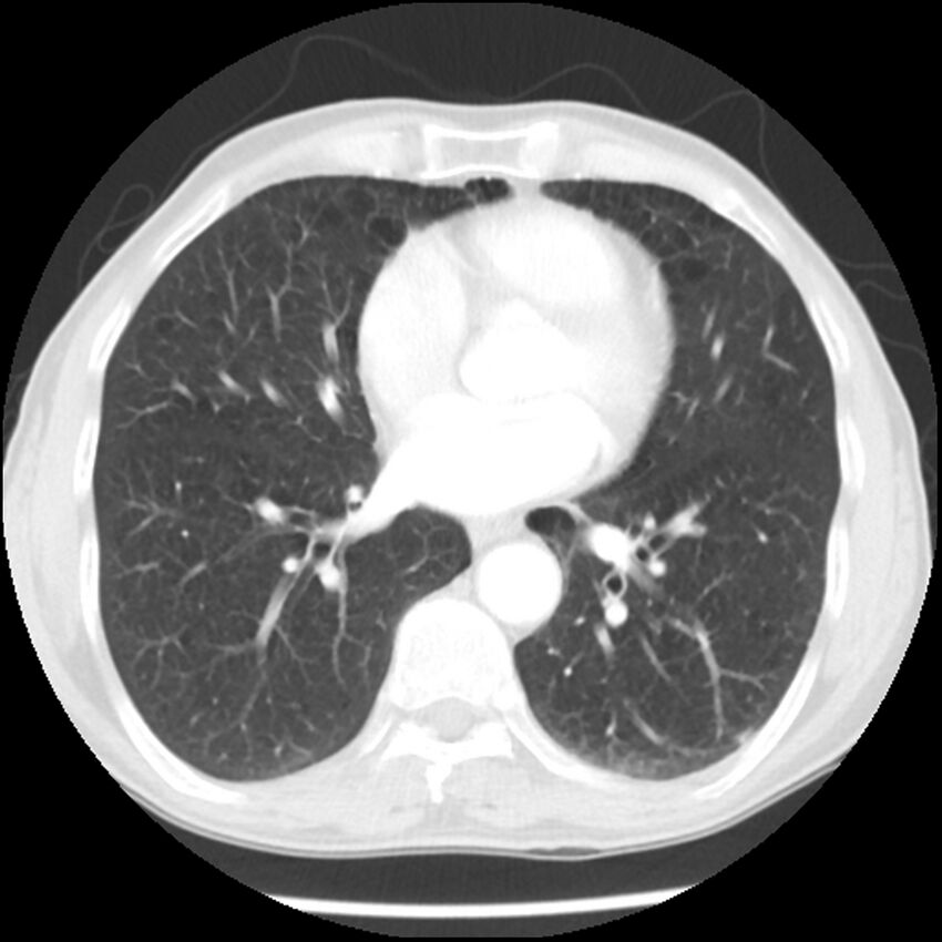Adenocarcinoma of the lung - micropapillary predominant (Radiopaedia 42446-45563 Axial lung window 45).jpg
