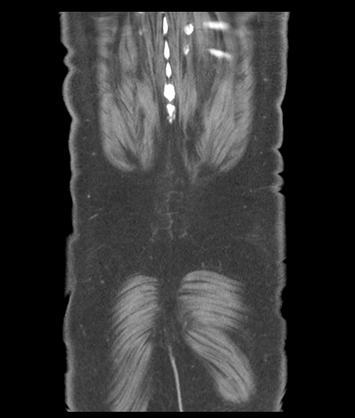 File:Adenocarcioma of rectum- T1 lesion (Radiopaedia 36921-38547 Coronal C+ portal venous phase 59).png