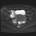 Adenomyosis and endometriotic cysts (Radiopaedia 82300-96367 Axial DWI 8).jpg