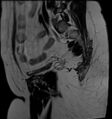 Adnexal multilocular cyst (O-RADS US 3- O-RADS MRI 3) (Radiopaedia 87426-103754 Sagittal T2 6).jpg