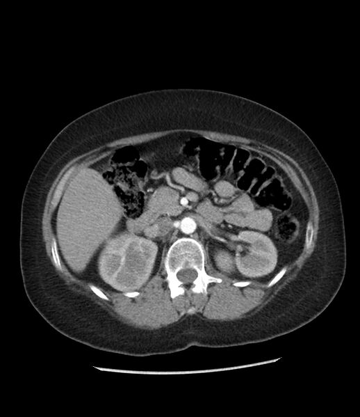 File:Adrenal cortical carcinoma with IVC invasion and thrombosis (Radiopaedia 34307-35597 Axial C+ arterial phase 34).jpg