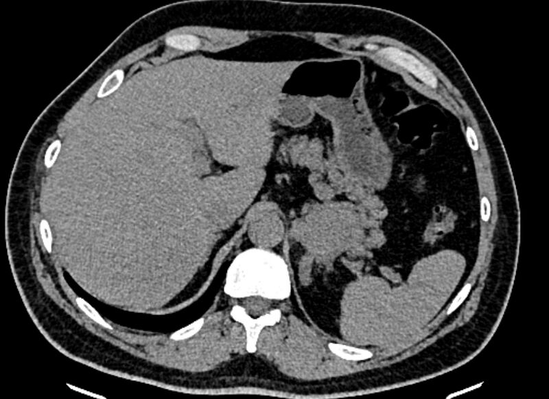 File:Adrenal metastases (Radiopaedia 73082-83791 Axial non-contrast 40).jpg
