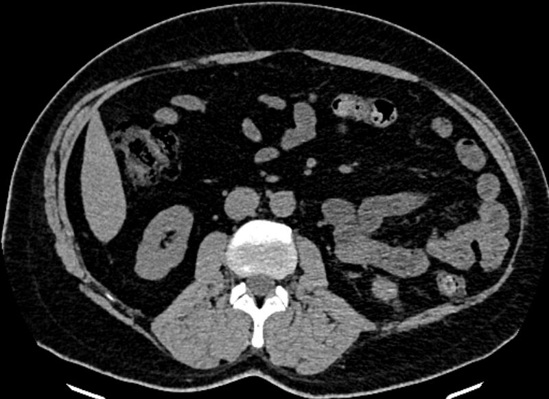 File:Adrenal metastases (Radiopaedia 73082-83791 Axial non-contrast 93).jpg