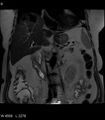 Adrenal myelolipoma (Radiopaedia 6765-7961 Coronal T2 9).jpg