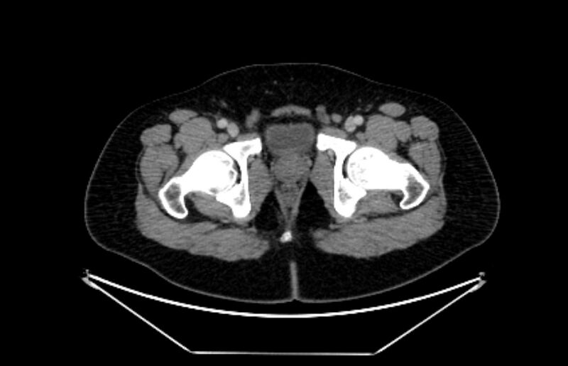 File:Adrenocortical carcinoma (Radiopaedia 80134-93438 Axial C+ portal venous phase 130).jpg