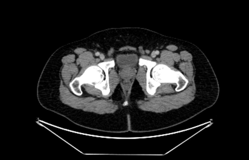 Adrenocortical carcinoma (Radiopaedia 80134-93438 Axial C+ portal venous phase 130).jpg