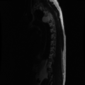 Aggressive vertebral hemangioma (Radiopaedia 39937-42404 Sagittal T2 2).png