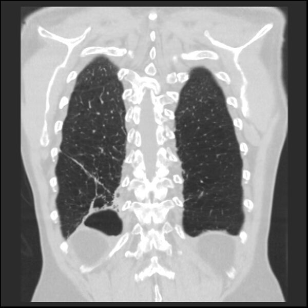 File:Alpha-1-antitrypsin deficiency (Radiopaedia 40993-43722 Coronal lung window 89).jpg