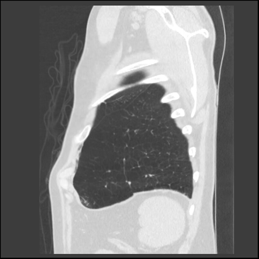 Alpha-1-antitrypsin deficiency (Radiopaedia 40993-43722 Sagittal lung window 32).jpg