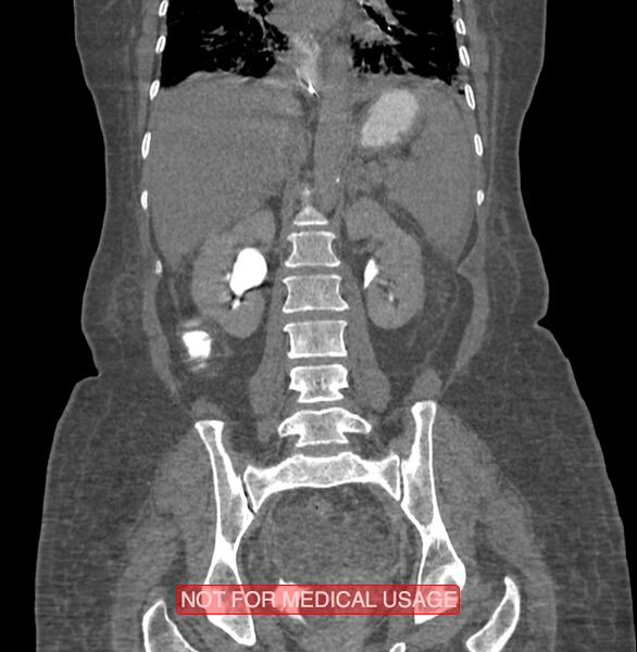 File:Amoebic enterocolitis with liver abscess (Radiopaedia 35100-36609 B 131).jpg