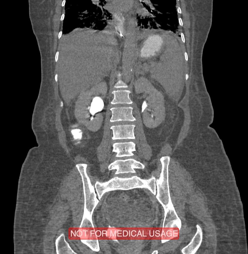 Amoebic enterocolitis with liver abscess (Radiopaedia 35100-36609 B 131).jpg