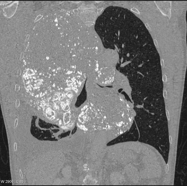 File:Amyloidoma - mediastinal (Radiopaedia 6711-7925 Coronal bone window 10).jpg