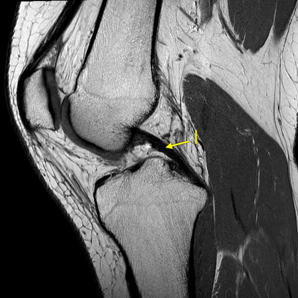 File:Anatomy Quiz (MRI knee) (Radiopaedia 43478-46865 A 11).jpeg