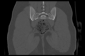 Aneurysmal bone cyst of ischium (Radiopaedia 25957-26094 Coronal bone window 37).png