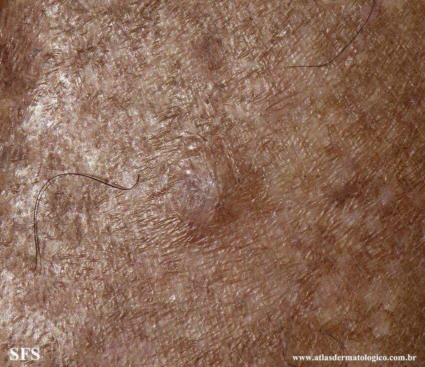 Angioleiomyoma (Dermatology Atlas 5).jpg