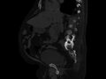 Ankylosing spondylitis (Radiopaedia 44609-48357 Sagittal bone window 45).jpg