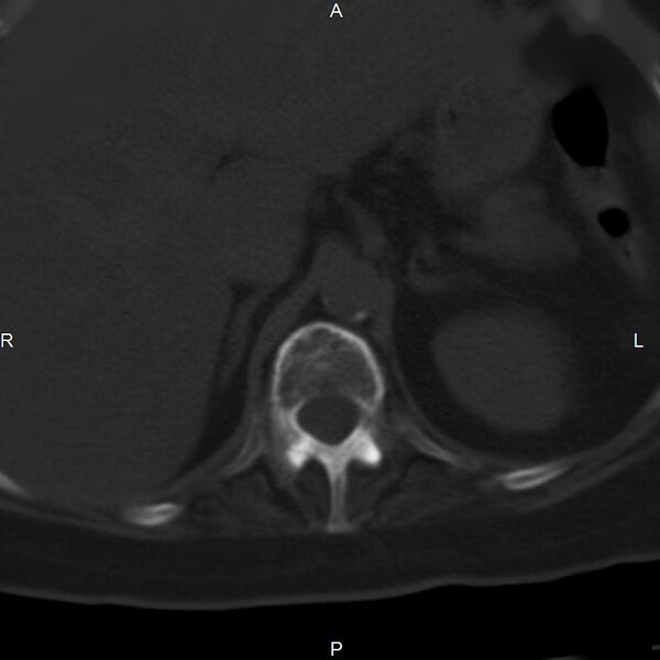 File:Ankylosing spondylitis (Radiopaedia 8748-9556 Axial bone window 16).jpg