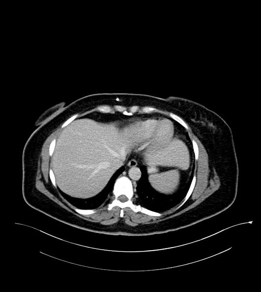 File:Anterior abdominal wall CSF pseudocyst (CSFoma) (Radiopaedia 79453-92571 A 15).jpg