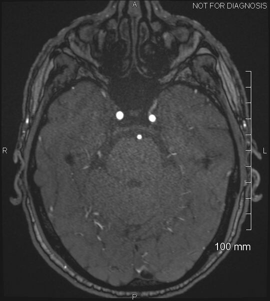 File:Anterior cerebral artery aneurysm (Radiopaedia 80683-94127 Axial MRA 73).jpg