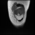 Anterior cruciate ligament tear, Wrisberg rip and bucket-handle tear of medial meniscus (Radiopaedia 75872-87266 Coronal T1 5).jpg
