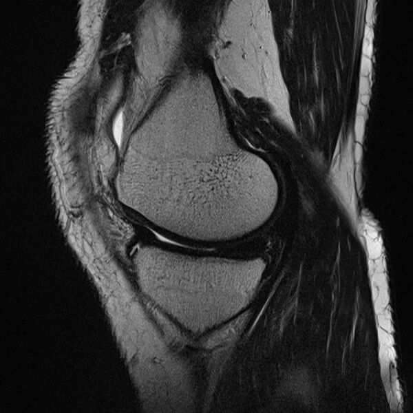 File:Anterior cruciate ligament tear - ramp lesion (Radiopaedia 71883-82322 Sagittal T2 18).jpg