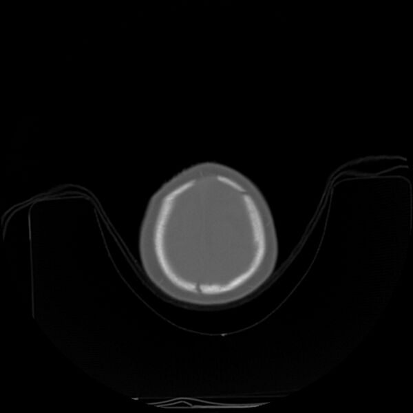 File:Anterior plagiocephaly (Radiopaedia 71836-82273 C 96).jpg