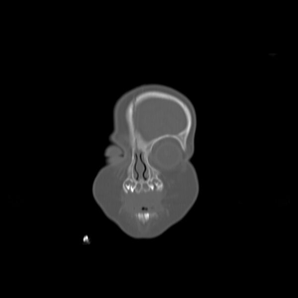 File:Anterior plagiocephaly (Radiopaedia 71836-82273 Coronal bone window 19).jpg